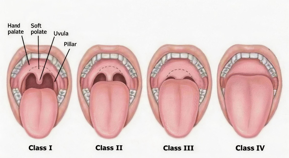 Mallampati grade example